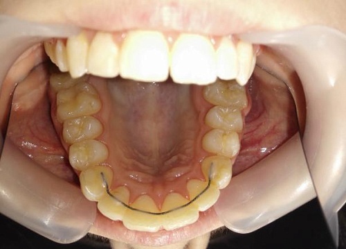 Лечение скученности зубов брекетами Damon