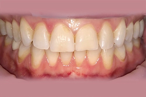 Установка на зубы виниров E-max