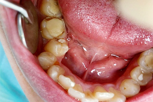 Лечение скрытого кариеса дистальной части зуба