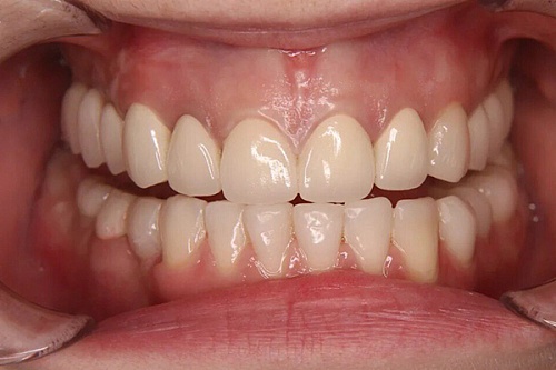 Ортопедическое лечение разрушенных зубов