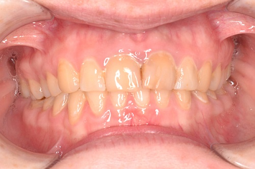 Комплексное лечение по восстановлению высоты прикуса и устранение последствий стираемости зубов 