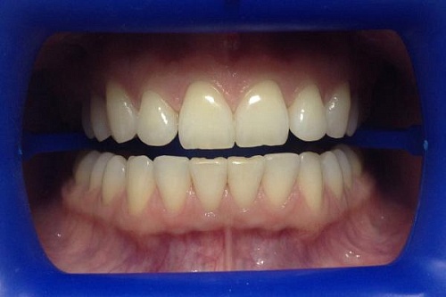 Профессиональное отбеливание зубов Zoom 4