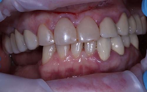 Протезирование передних зубов
