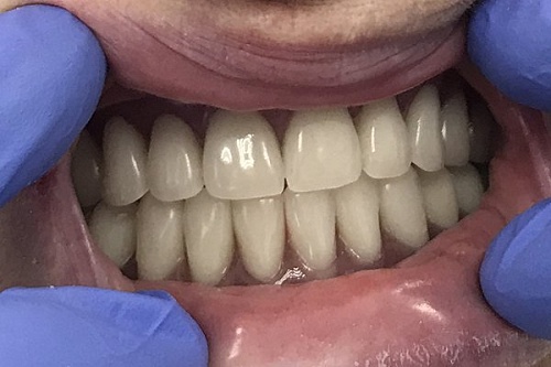 Полное протезирование на зубных имплантах