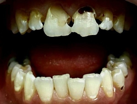 Художественная реставрация передних зубов