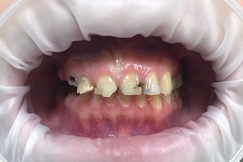 Ортопедическое лечение разрушенных зубов