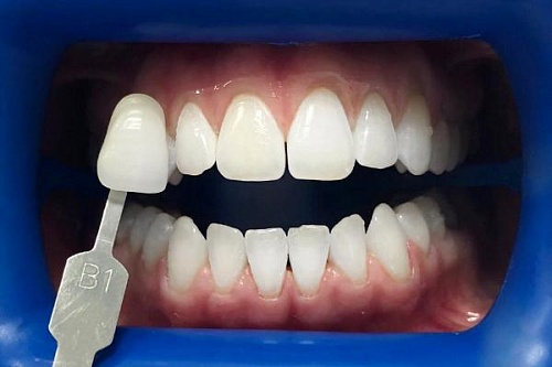 Отбеливание зубов системой Philips Zoom 4