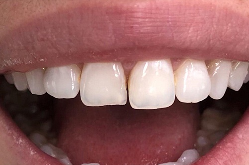 Исправление верхних центральных зубов