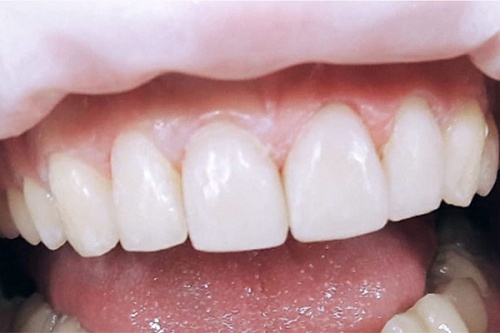 Лечение кариеса переднего зуба