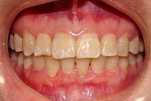 Исправление скученности зубов во фронтальном отделе