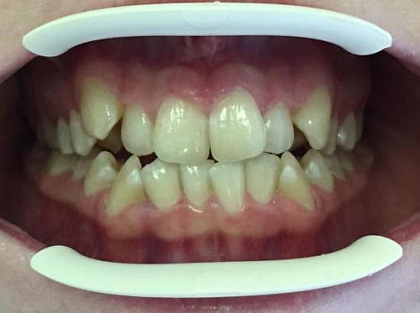 Выравнивание зубов металлическими брекетами Damon Q