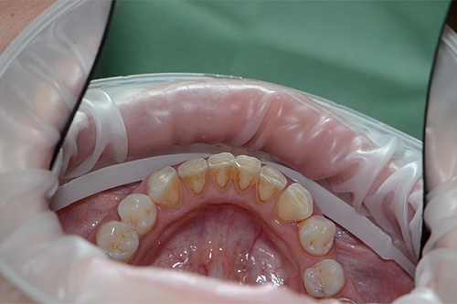 Удаление зубного налета с помощью профгигиены