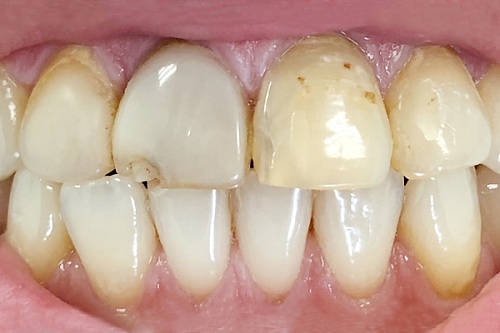 Протезирование зубов керамическими коронками