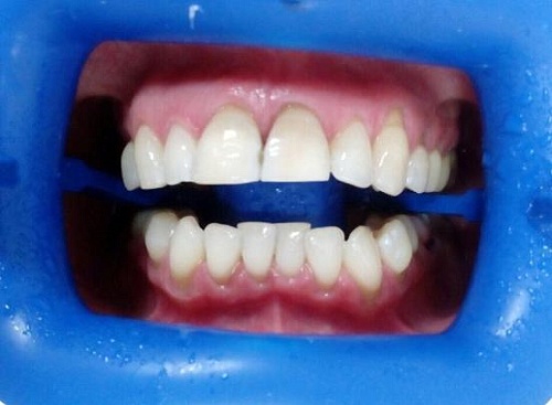 Клиническое отбеливание зубов Zoom White Speed