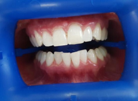 Удаление пигментации на зубах системой Zoom 4