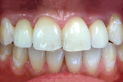 Протезирование коронками на имплантатах