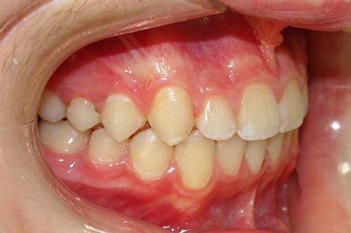 Исправление неправильного положения зубов брекетами