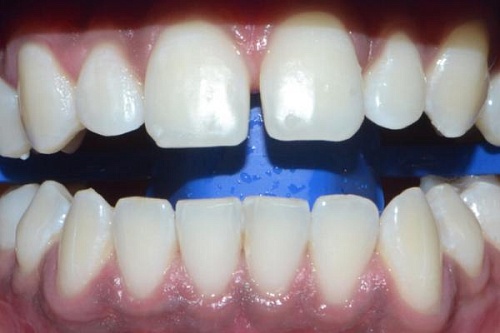 Профессиональное осветление зубной эмали
