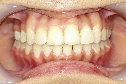 Устранение скученности зубов металлическими брекетами Damon Q