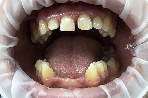 Реставрация зубов верхней челюсти