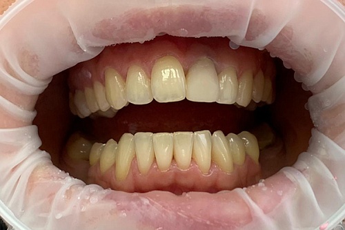 Отбеливание зубов системой Philips Zoom white speed