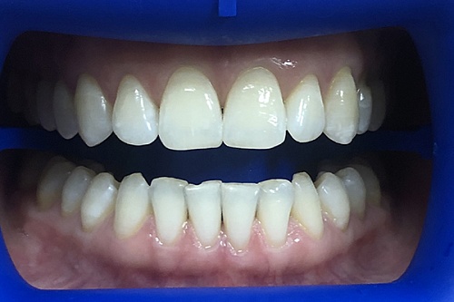 Отбеливание зубов системой Philips Zoom White Speed