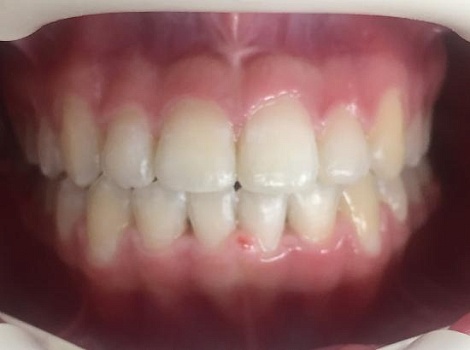 Выравнивание зубов металлическими брекетами Damon Q
