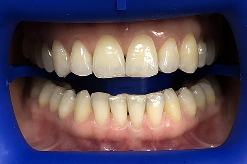 Отбеливание зубов системой Philips Zoom White Speed