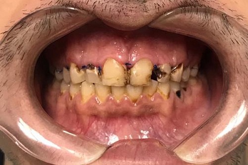 Лечение и протезирование зубов винирами E-max