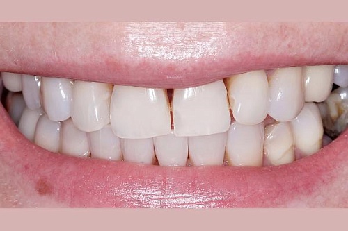 Художественная реставрация фронтальных зубов