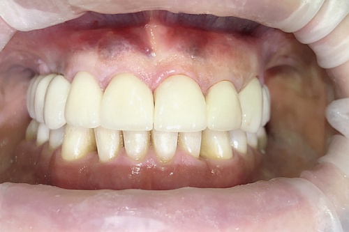Установка виниров на фронтальные зубы и коронок из диоксида циркония на имплантах 
