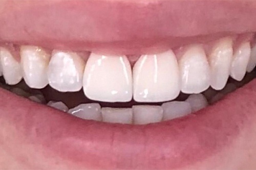 Исправление верхних центральных зубов
