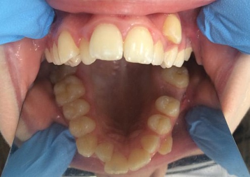 Лечение скученности зубов брекетами Damon