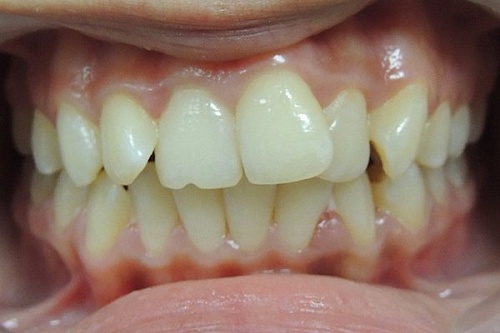 Устранение скученности зубов металлическими брекетами Damon Q