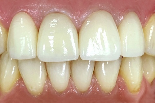 Протезирование зубов керамическими коронками