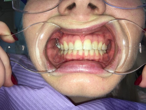 Коррекция сложного случая искривления зубов