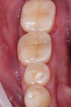 Восстановление жевательных зубов керамическими культевыми вкладками