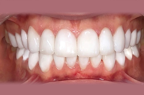 Установка на зубы виниров E-max