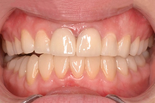 Комплексное лечение по восстановлению высоты прикуса и устранение последствий стираемости зубов 