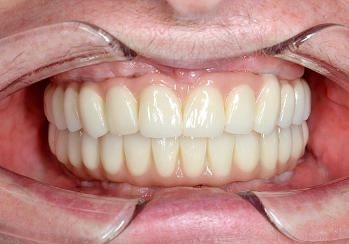 Тотальная реконструкция улыбки с помощью имплантов и керамических коронок E-max