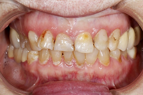Комплексное лечение передних зубов