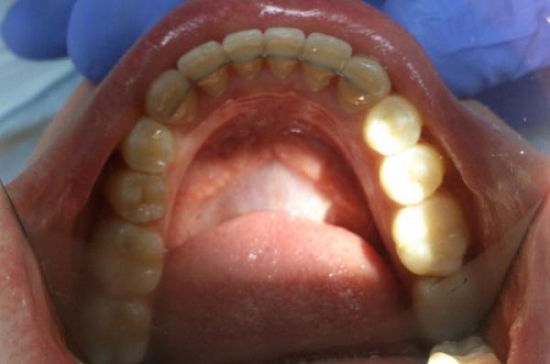 Выравнивание зубов на нижней челюсти брекетами Damon Q