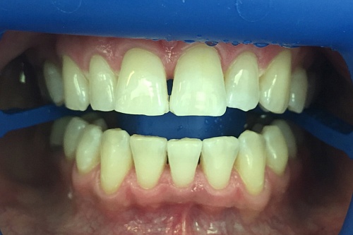 Отбеливание пожелтевших зубов системой Zoom 4