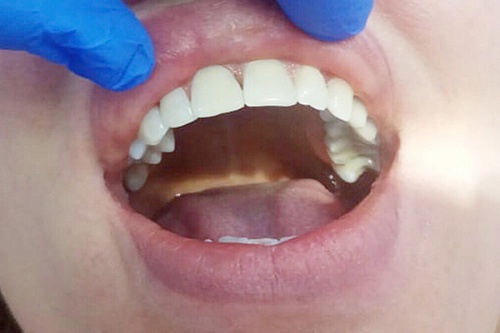 Восстановление зуба эстетической реставрацией