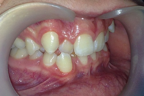 Исправление неправильного положения зубов брекетами