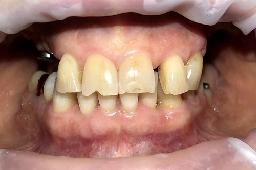 Установка виниров на фронтальные зубы и коронок из диоксида циркония на имплантах 