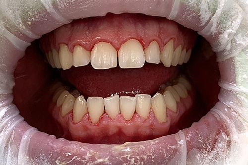 Биогигиена и отбеливание зубов