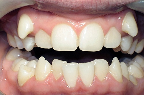 Устранение скученного положения зубов